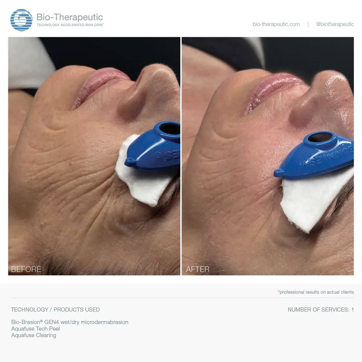 Bio-Therapeutic Bio-Brasion GEN4, packaging view