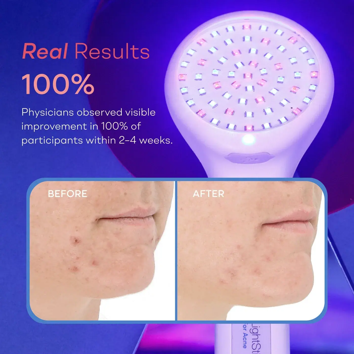 LightStim LightStim for Acne, alternate view