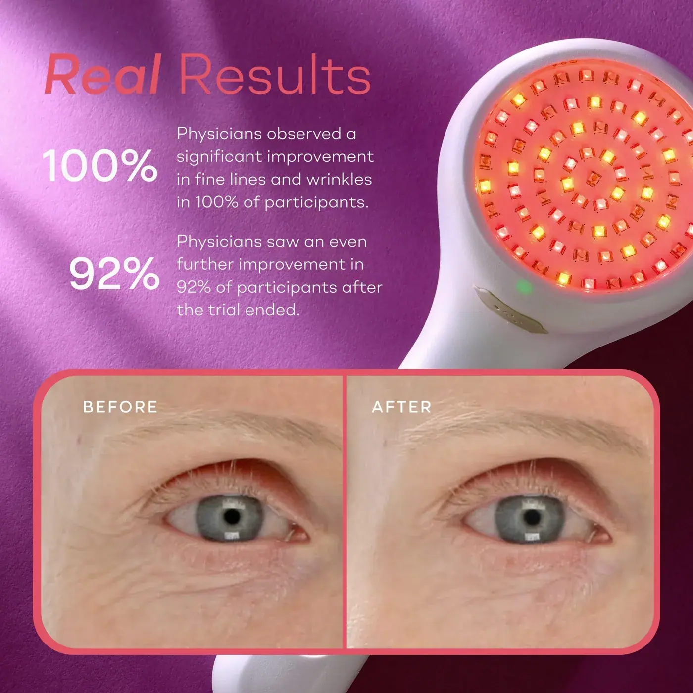 LightStim LightStim for Wrinkles, alternate view